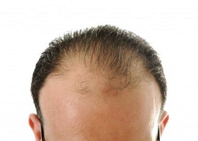 ¿El monohidrato de creatina causa pérdida de cabello?